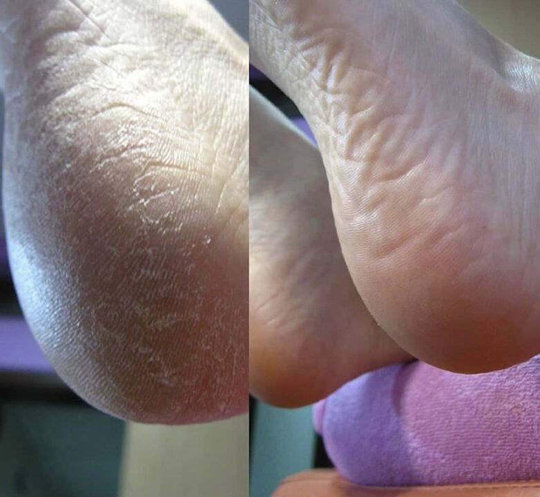 Photo of the heel of the foot before and after using the Zenidol cream