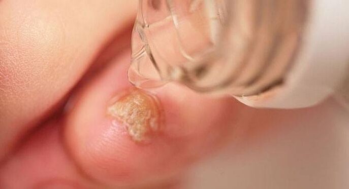 drops of the fungus on the toenails