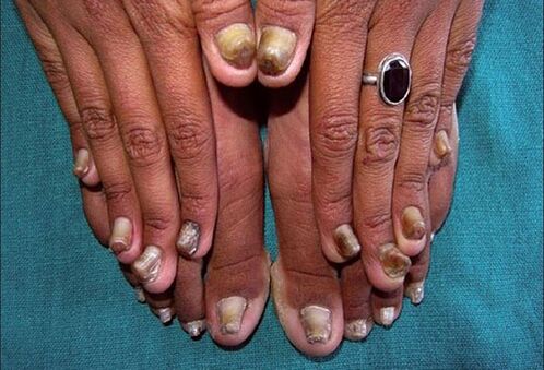 fungus on the fingernails and toenails