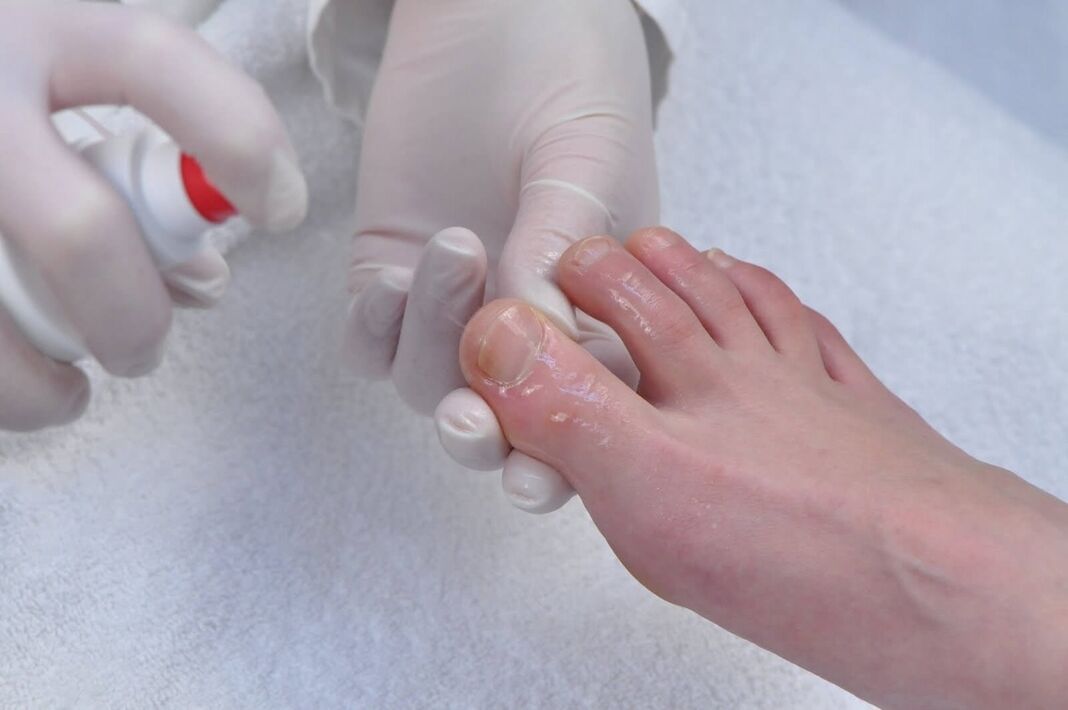 How to treat the nail fungus