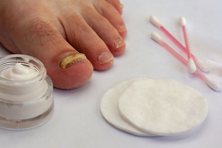 Mushroom finger treatment with mushroom cream