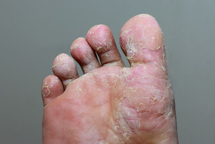 Severe stadium of mycopes of the fingers of the fingers