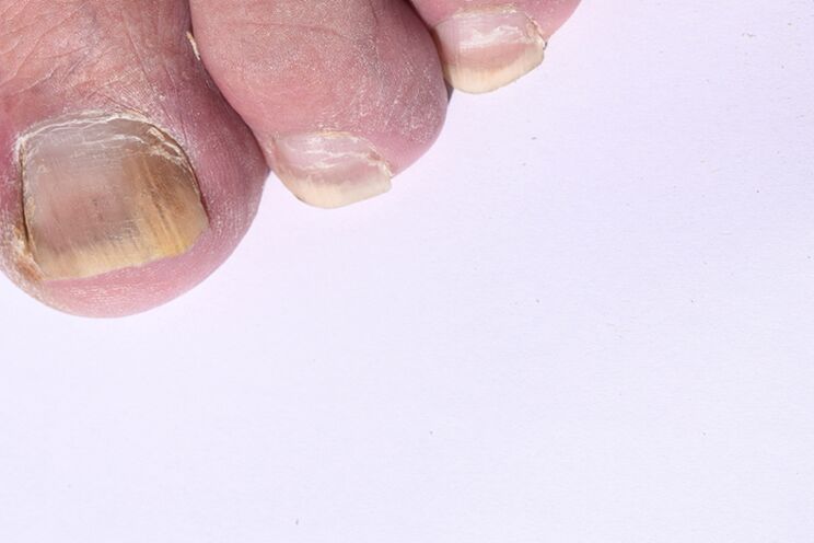 The initial phase of the mycosis of the nails on the legs