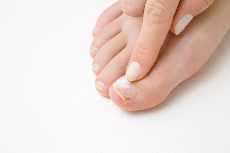 Treatment of the fingers with ointment from the mushroom