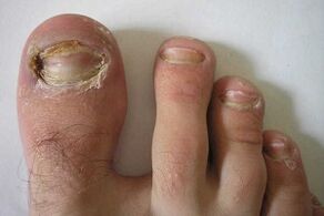 damage to toe nails due to a fungal infection