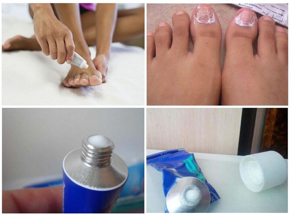 Pharmaceutical preparations effective against nail fungus