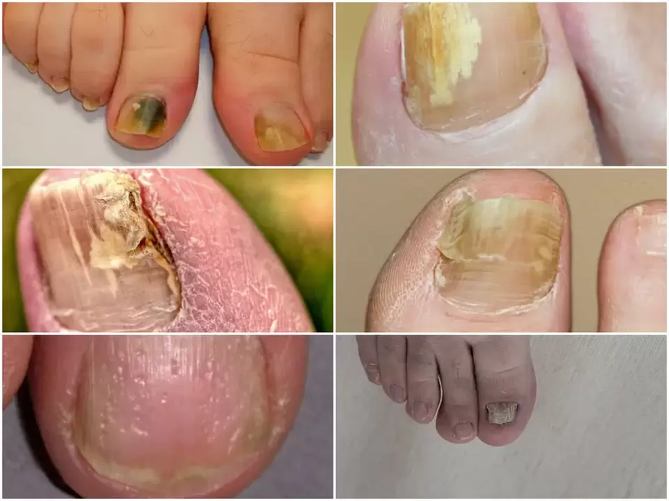 Symptoms of onychomycosis changes in the color and structure of the nails