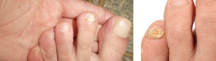 photos of manifestations of fungus on the toenails