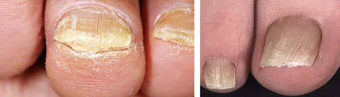 damage to the nails with a fungal infection